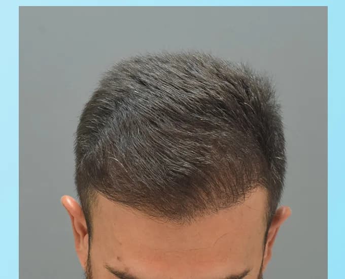 The same patient after a hair transplant, rebuilt frontal hairline