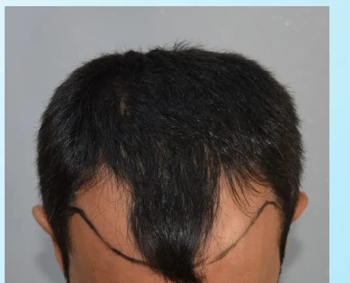 Male patient before a hair transplant, receding corners and a thinning frontal hairline