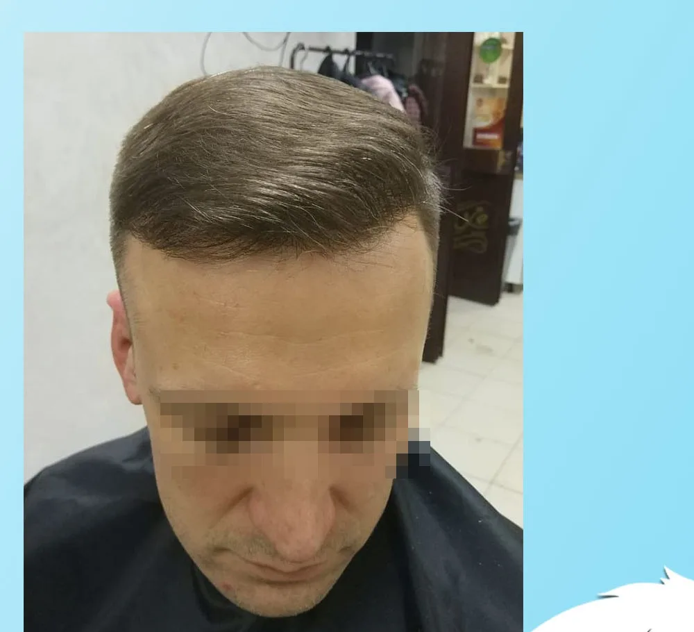 The same patient after a hair transplant, front and crown restored