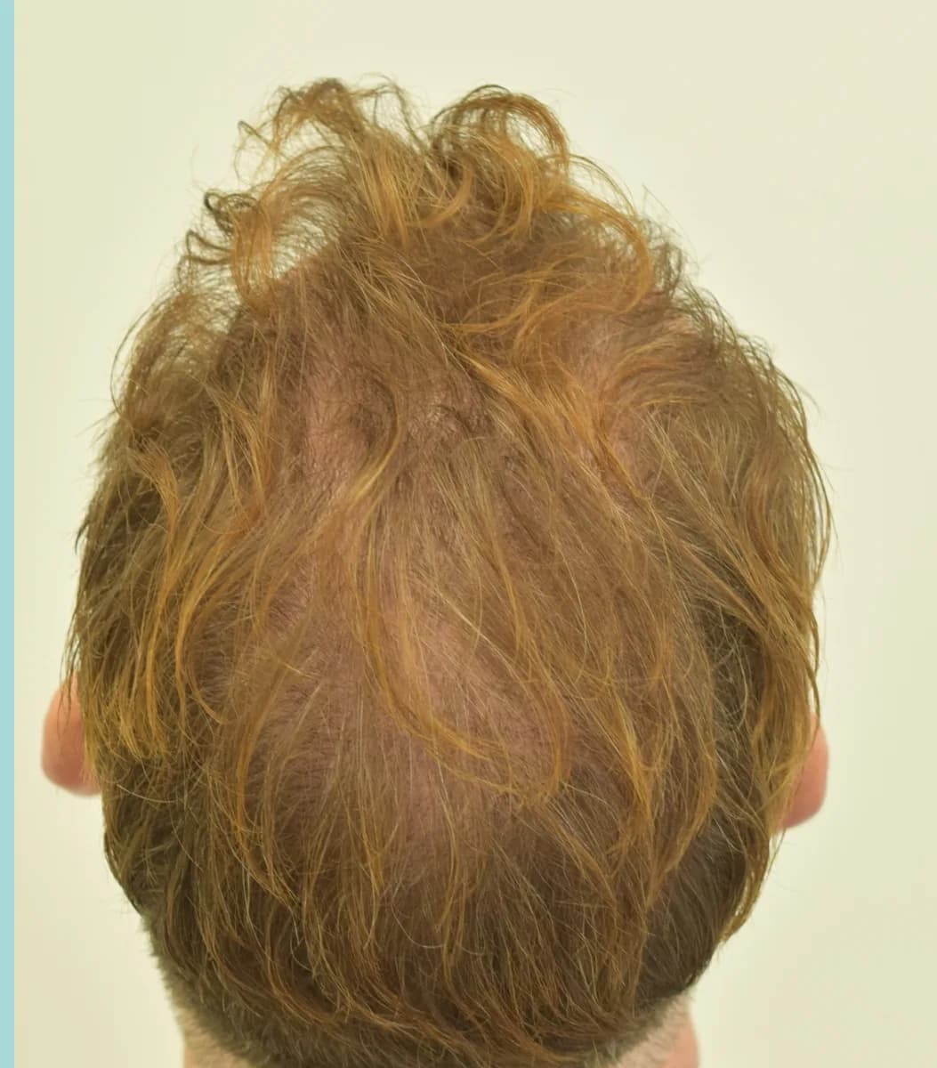 The same patient after a hair transplant, restored mid-scalp and crown density