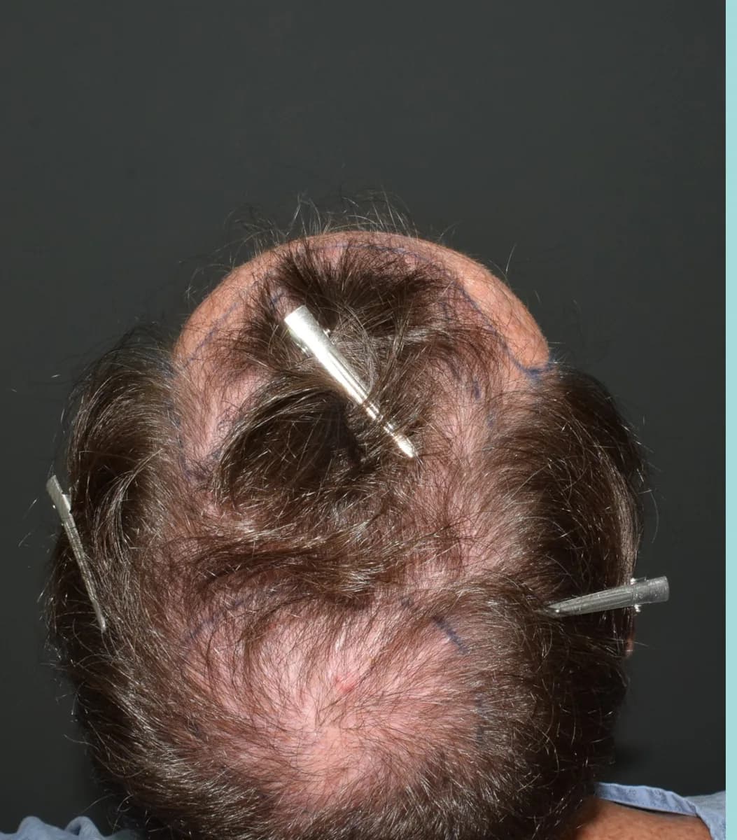 Male patient before a hair transplant, thinning mid-scalp and crown