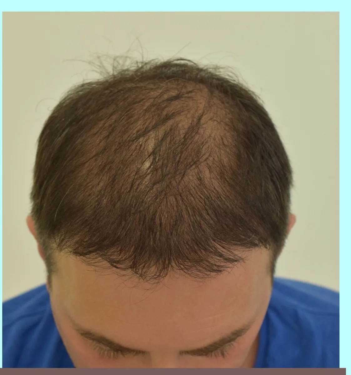 The same patient after a hair transplant, density restored across the scalp