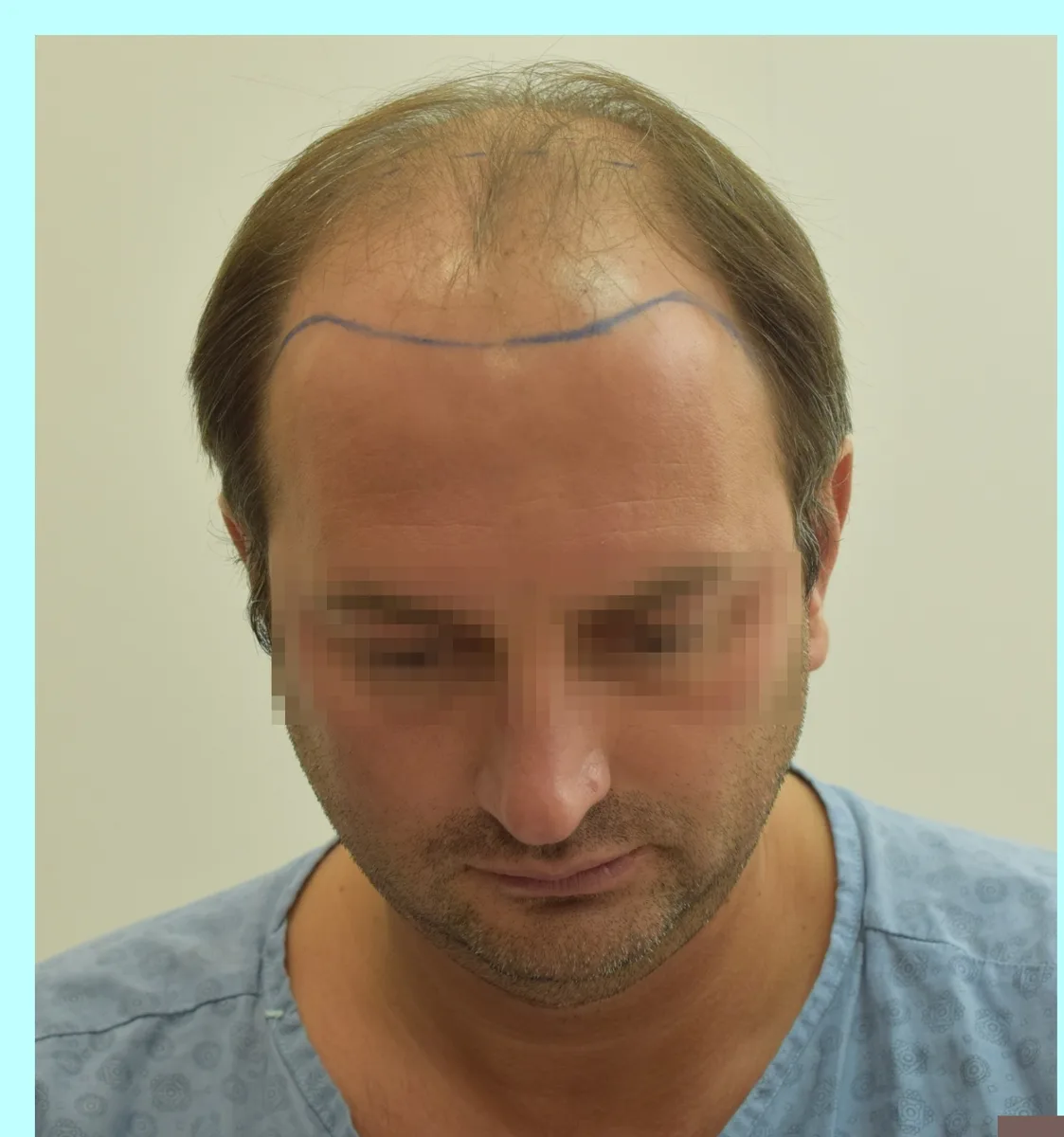 Male patient before a hair transplant, extensive thinning across the scalp