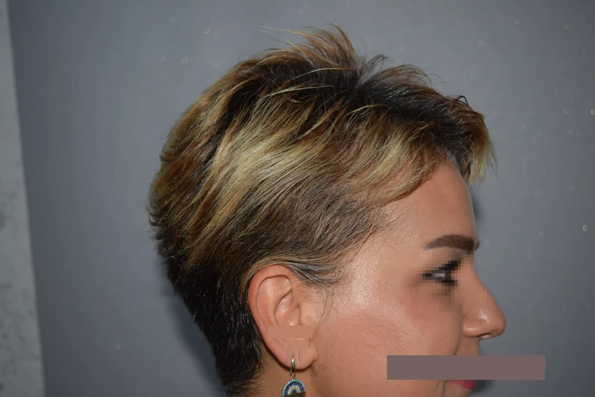 The same female patient six months after a hair transplant, side gaps filled and front restored