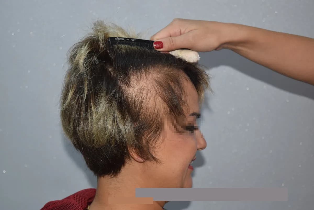 Female patient before a hair transplant, dense gaps at the side and thinning front