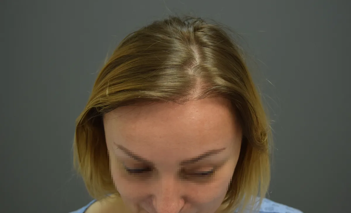 The same female patient after a hair transplant, hairline lowered to a natural position