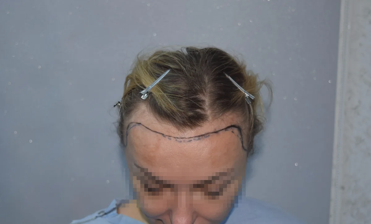 Female patient before a hair transplant, congenitally high hairline with pre-treatment planning lines