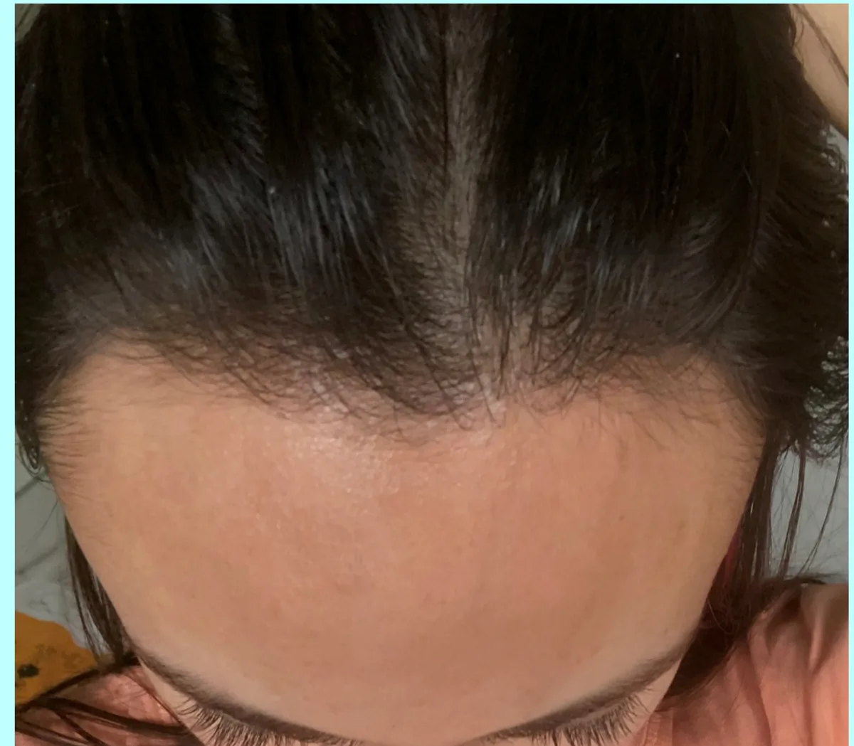 The same female patient after a hair transplant, a lower, fuller hairline at eight months