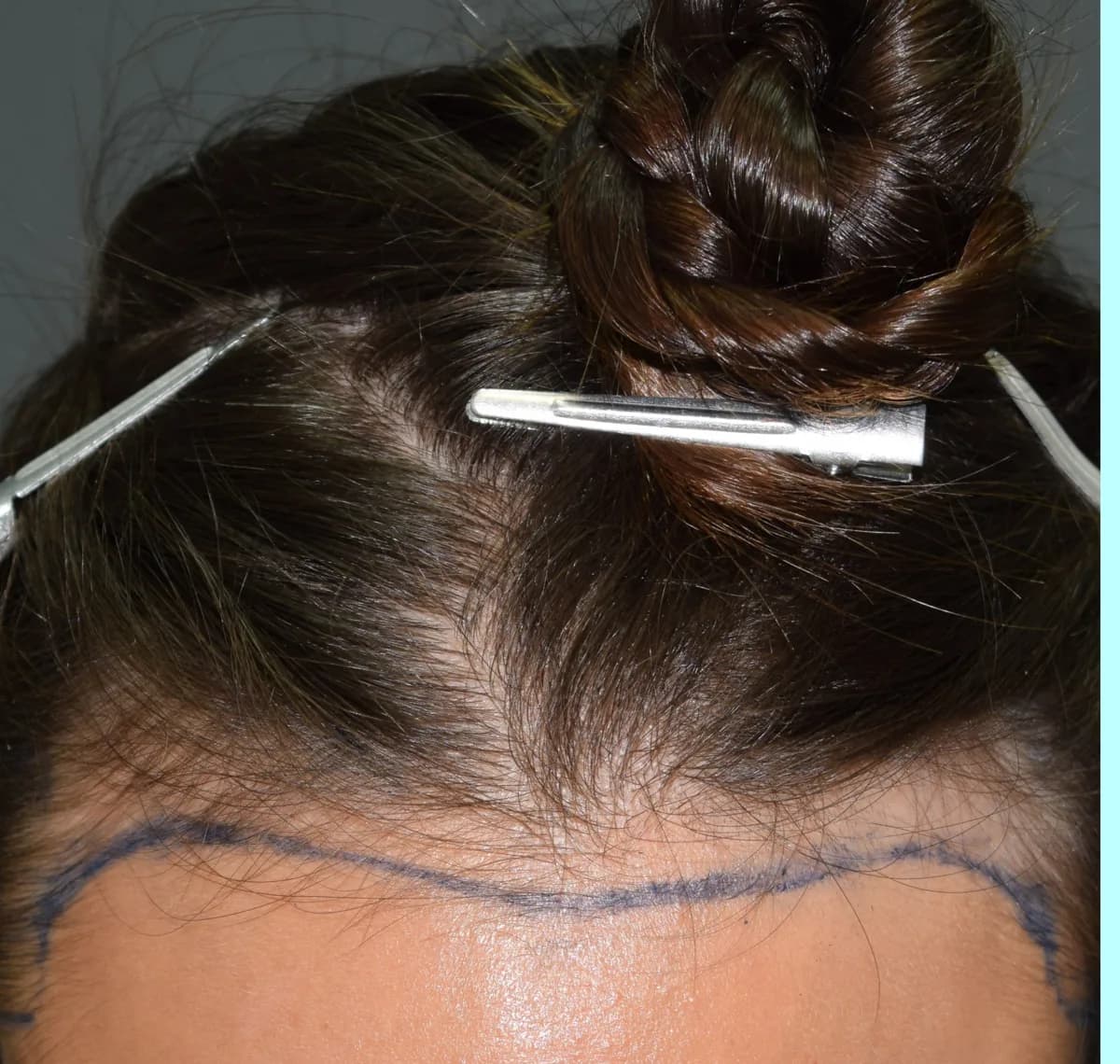 Female patient before a hair transplant, a naturally high hairline with pre-treatment planning lines