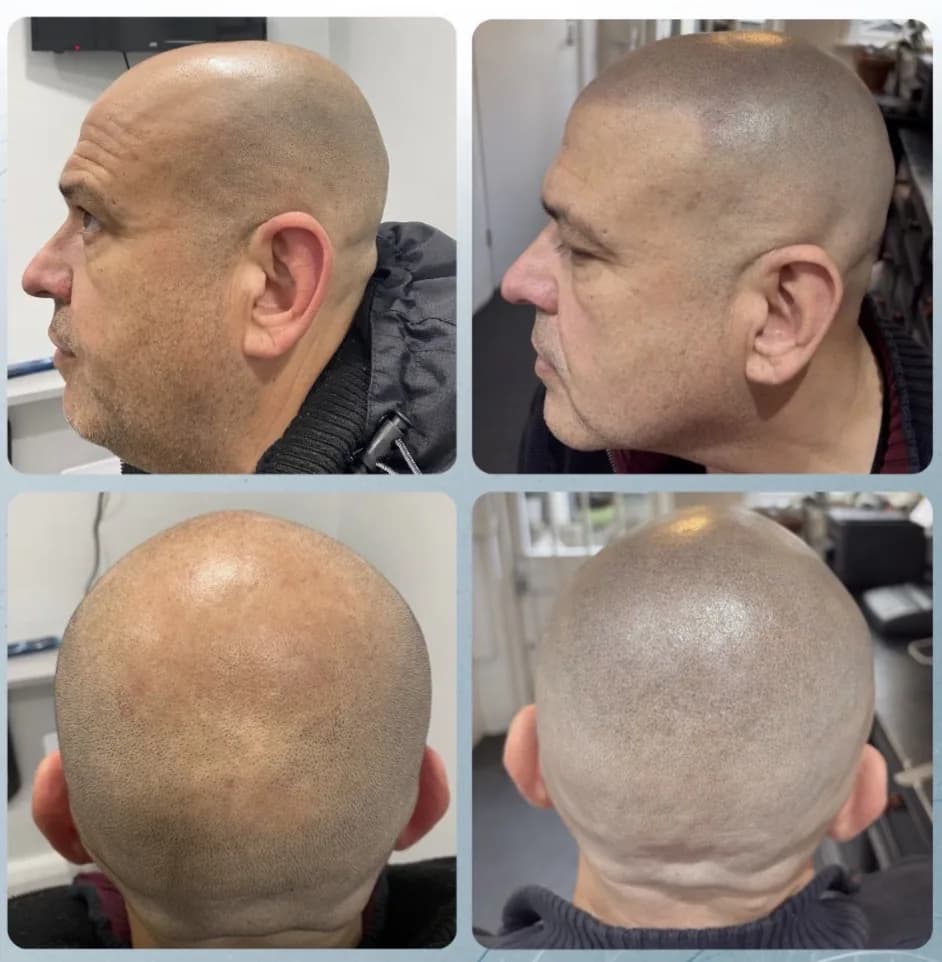Scalp micropigmentation before and after by Filippo Peranzani: a patchy, receding hairline restored to a defined, closely shaved look, side and back views.