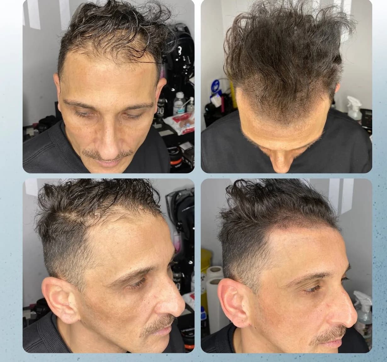 Scalp micropigmentation before and after by Filippo Peranzani: density added into thinning hair that is kept longer, reducing scalp show-through.