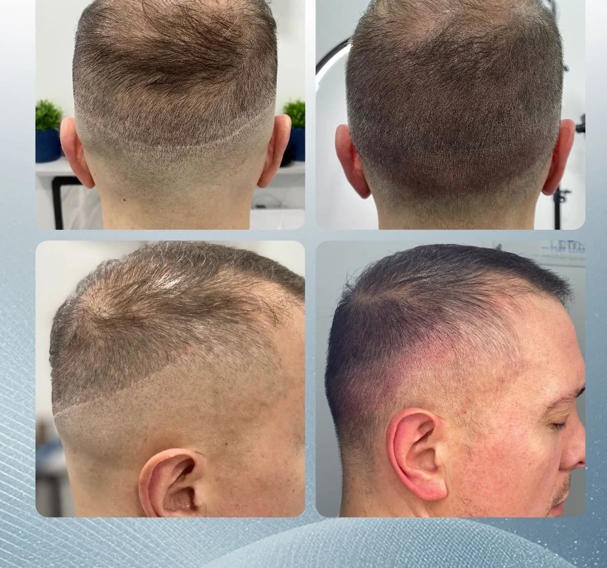 Scalp micropigmentation before and after by Filippo Peranzani: a linear FUT hair transplant scar camouflaged and blended into the surrounding hair.