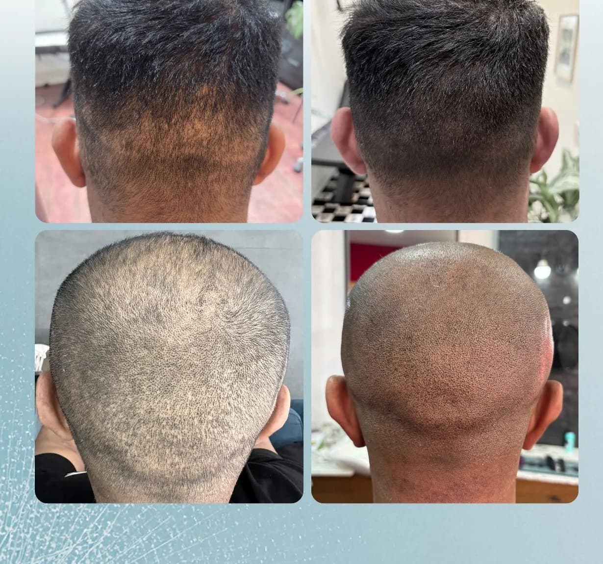Scalp micropigmentation before and after by Filippo Peranzani: dot scarring from FUE surgery blended into the donor area.