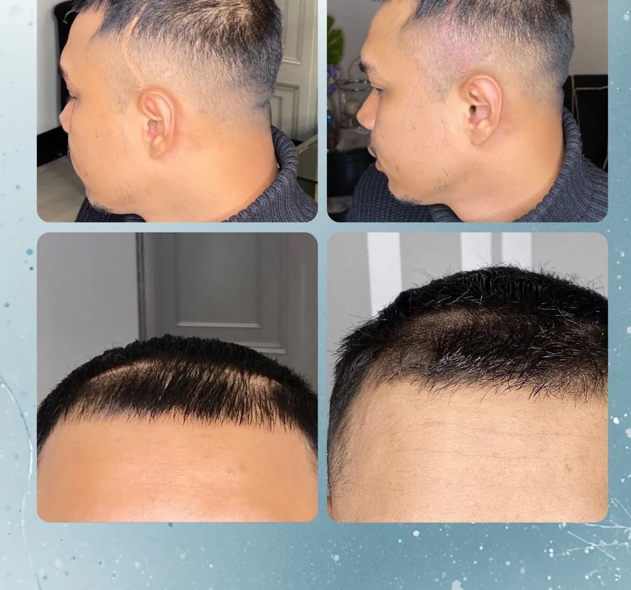 Scalp micropigmentation before and after by Filippo Peranzani: an injury scar on the scalp softened to blend with the surrounding hair.