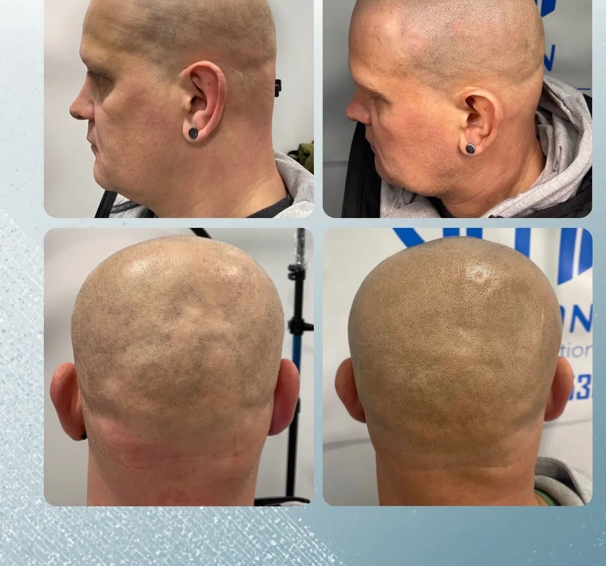 Scalp micropigmentation before and after by Filippo Peranzani: patchy alopecia hair loss given even, natural-looking density.