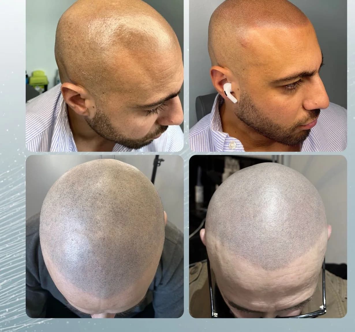 Scalp micropigmentation before and after by Filippo Peranzani: faded SMP refreshed to restore depth and a sharp hairline.