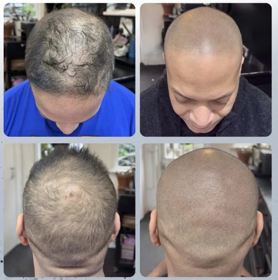 Scalp micropigmentation before and after by Filippo Peranzani: diffuse thinning on top given the look of a full shaved head, top and back views.
