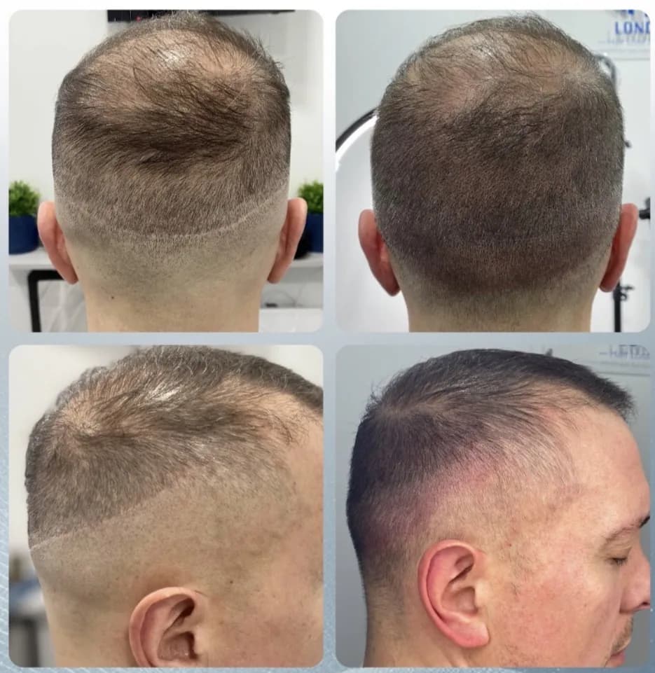 Scalp micropigmentation before and after by Filippo Peranzani: a thinning crown and soft hairline given added density and definition.