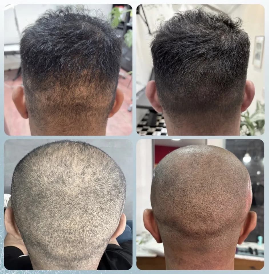 Scalp micropigmentation before and after by Filippo Peranzani: pigment blended into existing dark hair to reduce the contrast of a thinning crown.