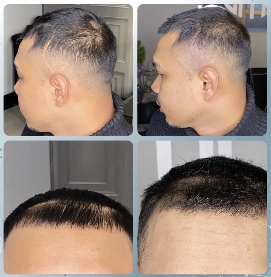 Scalp micropigmentation before and after by Filippo Peranzani: receded temples and hairline rebuilt into a defined shape, side and front views.