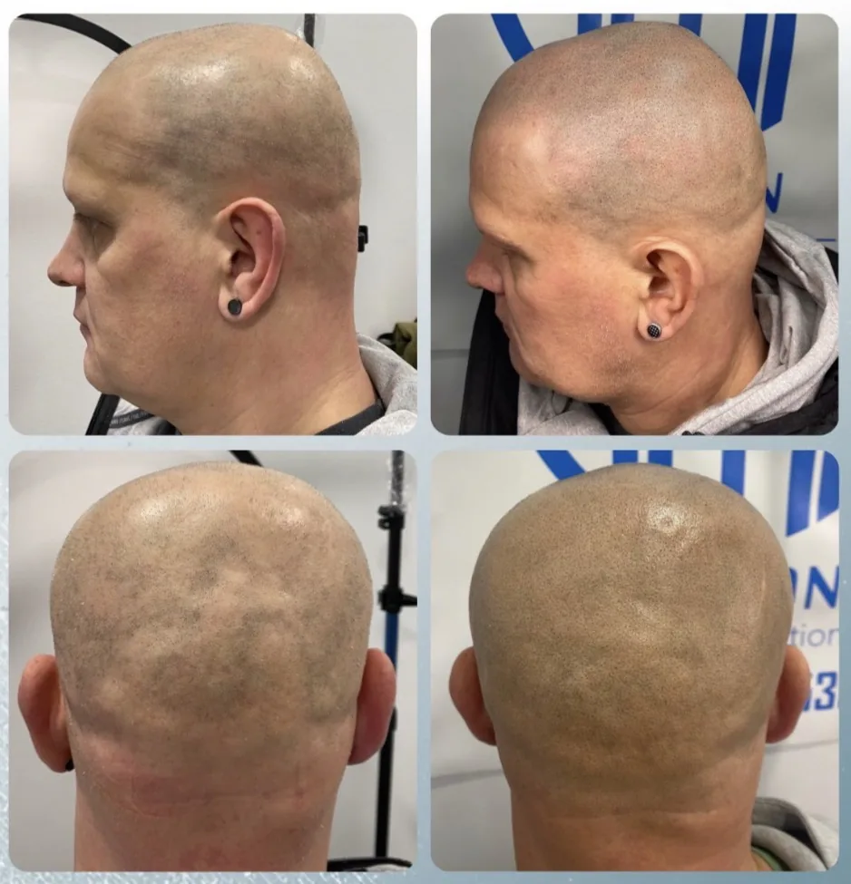 Scalp micropigmentation before and after by Filippo Peranzani: an uneven, scarred scalp given an even, natural shaved look, side and back views.