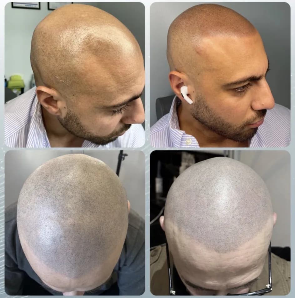 Scalp micropigmentation before and after by Filippo Peranzani: a bald, uneven crown given dense even coverage, side and top views.