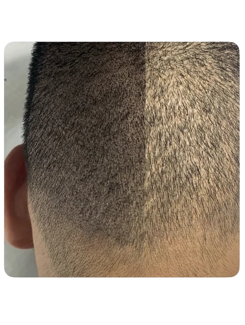 Scalp micropigmentation close-up by Filippo Peranzani: a natural, feathered hairline blending into a closely shaved scalp.