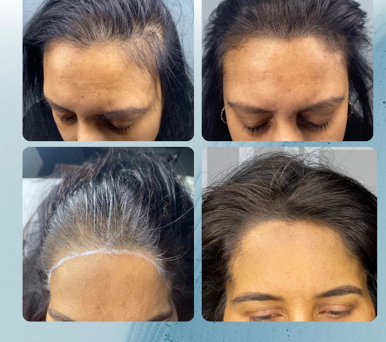 Female scalp micropigmentation before and after by Filippo Peranzani: a thinning parting and hairline given the appearance of greater density.