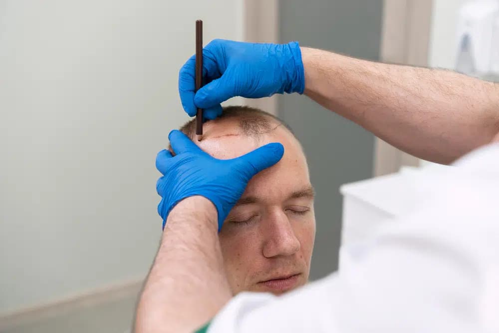 Male DHI Hair Transplant