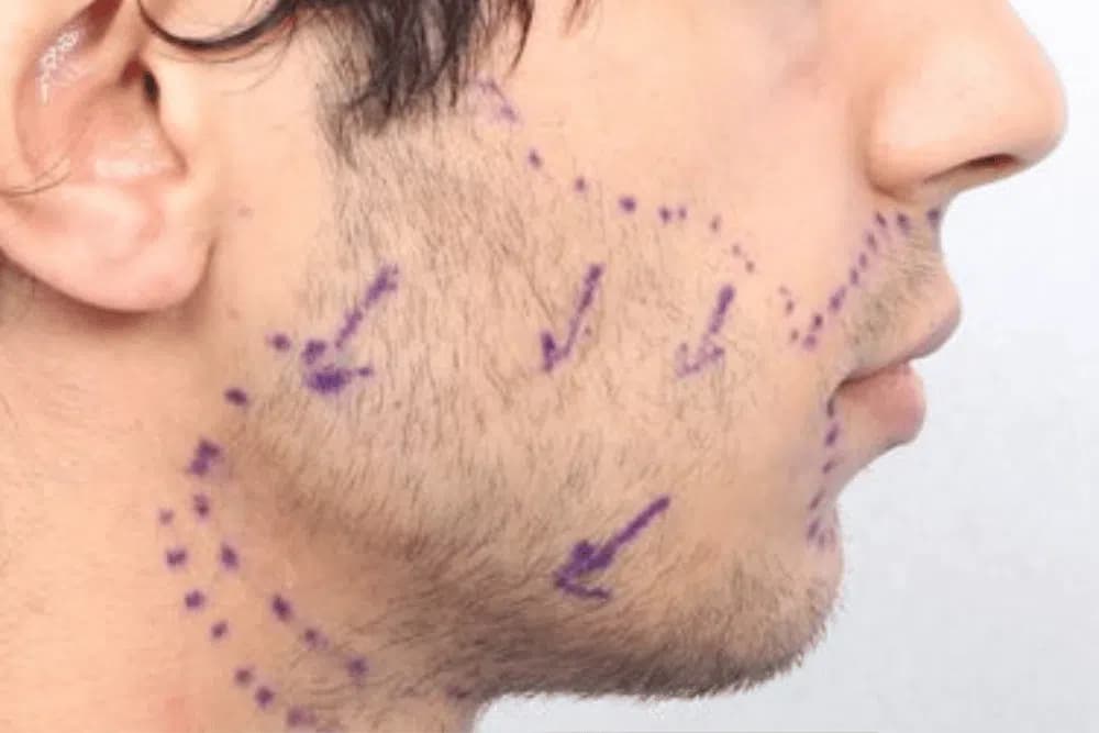 Beard FUE Transplant
