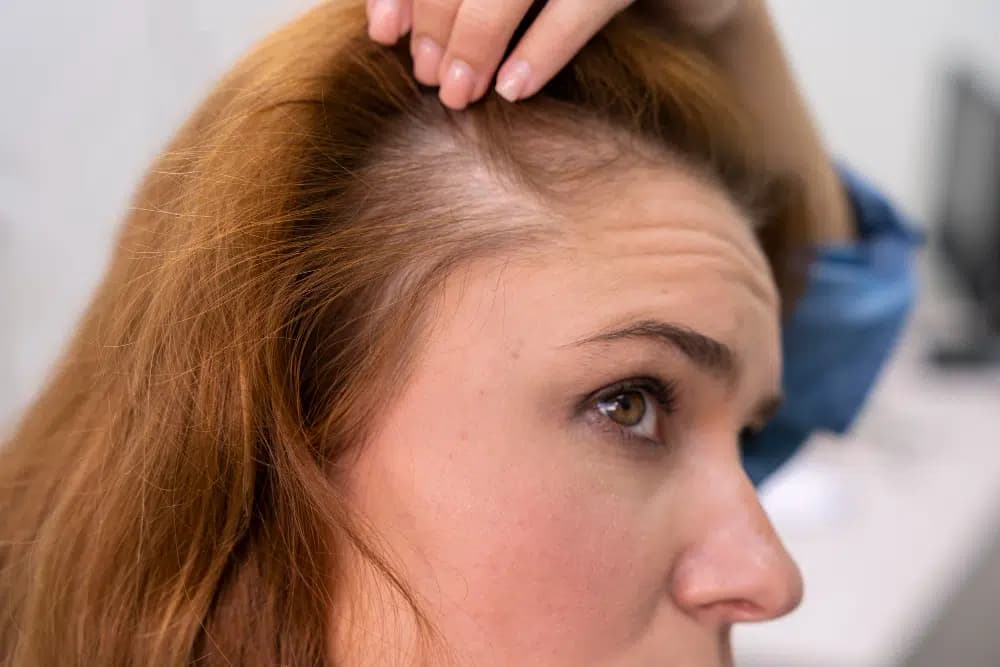 Female FUE Hair Transplant