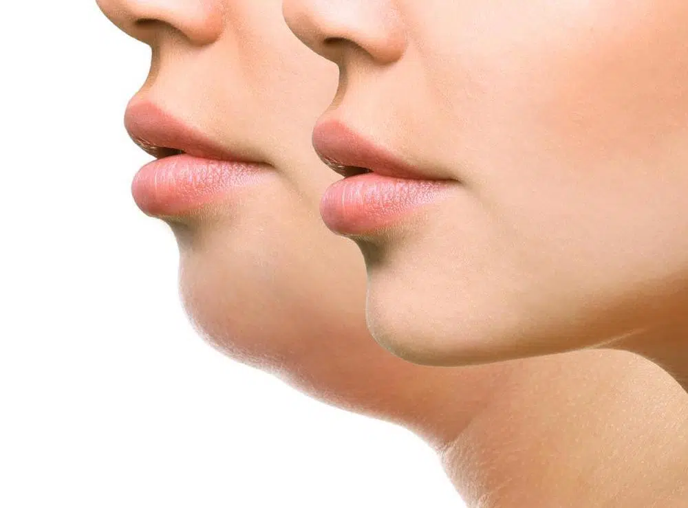 Jawline Contouring with fillers – Juvederm (1ml)