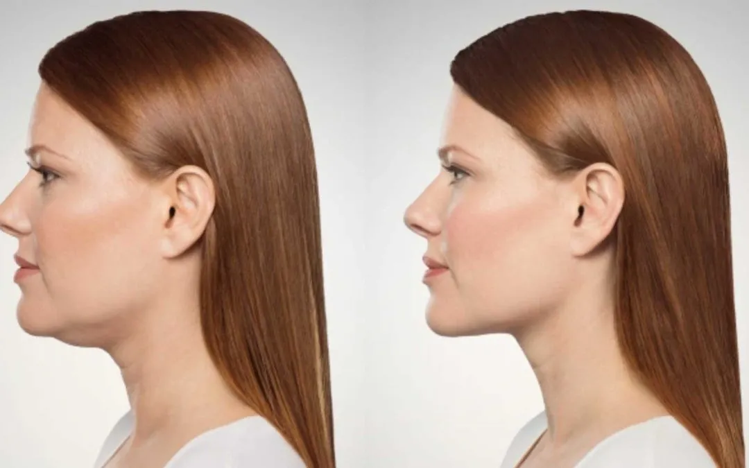 Chin & Jawline Sculpting – Aqualyx