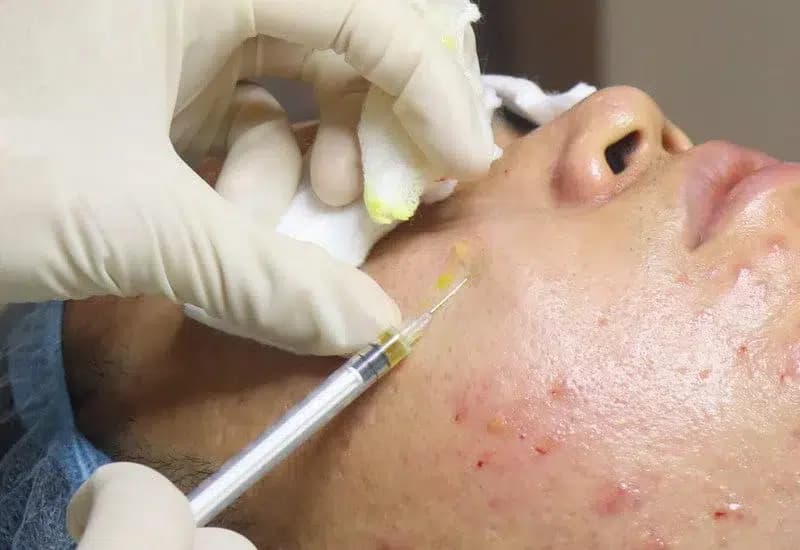Skin Rejuvenation Injections (Scar Treatment)
