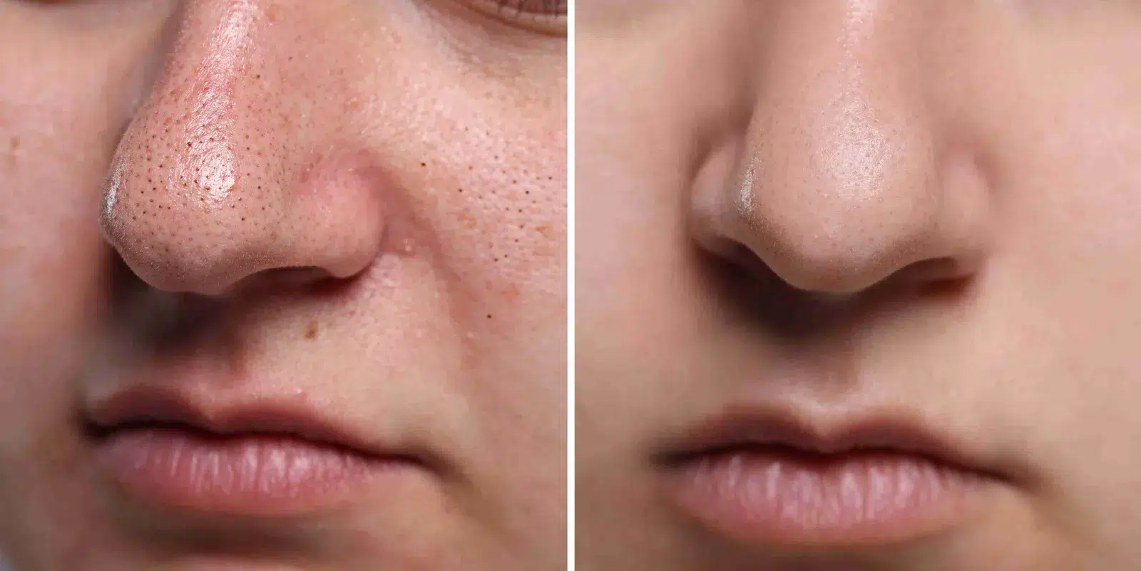 Skin Rejuvenation Injections (Pore Tightening Treatment)