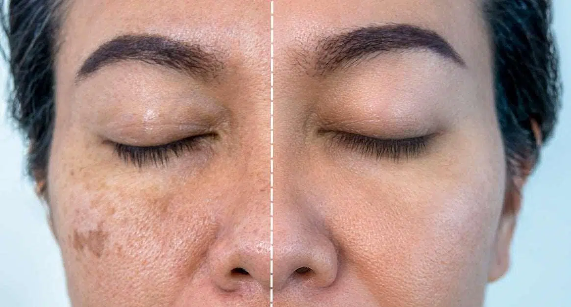 Skin Rejuvenation Injections (Fine Wrinkles Treatment)