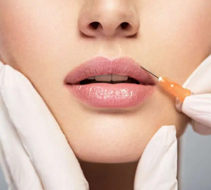 Lip Filler, Lip Enhancement, Soft Volume Correction to Defined Contour