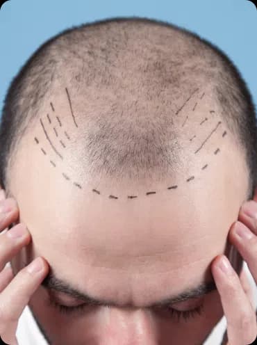 Male FUE Hair Transplant