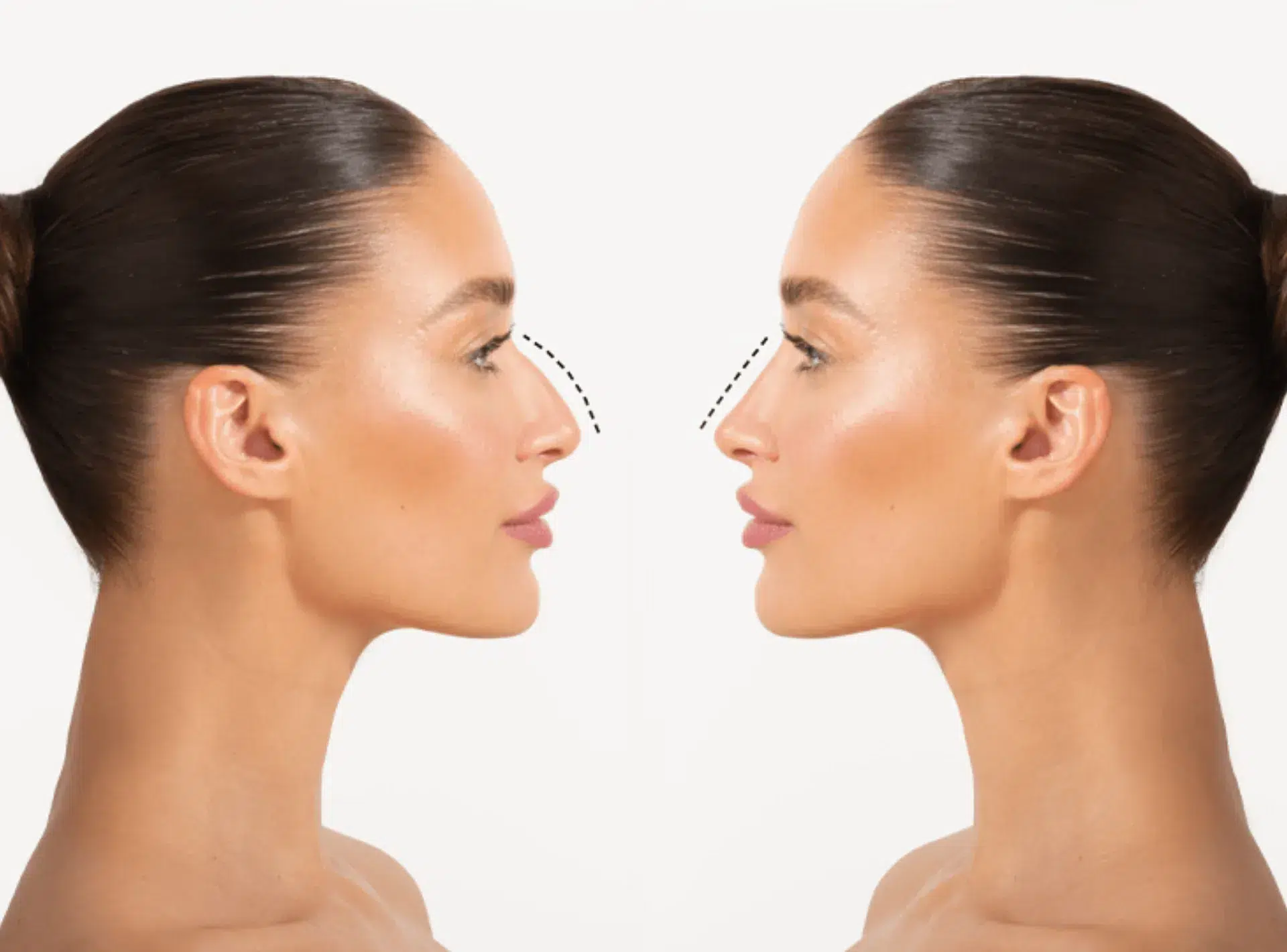 Nose Enhancement (Non-Surgical)