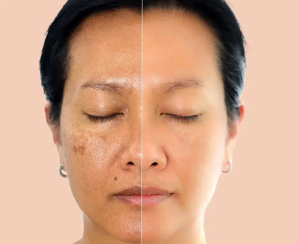 Skin Rejuvenation Injections (Sun Damage)