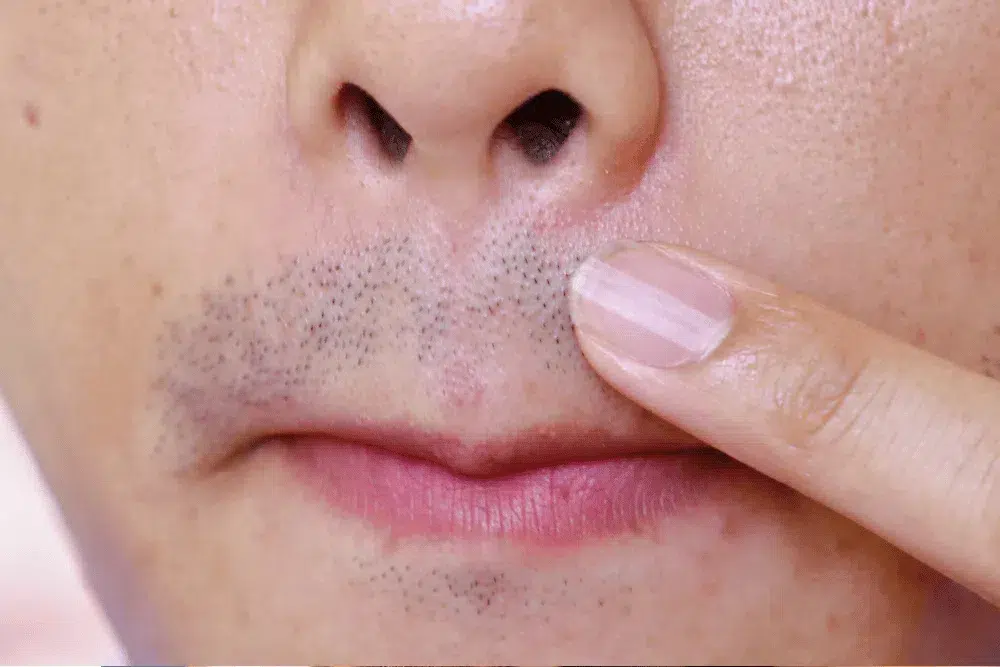 Moustache Transplant